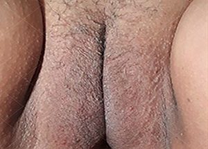 EMBELLECIMIENTO VULVO VAGINAL 3D1