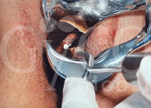 rej vaginal